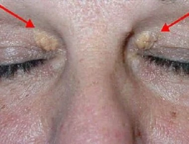 Τι αποκαλύπτουν για την υγεία σας αυτά τα σημάδια στα μάτια;